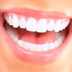 Zähne bleaching Glarus